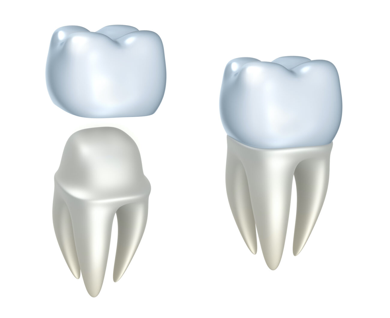 A DENTAL CROWN in TUCKAHOE NY can be used to help treat a variety of dental issues