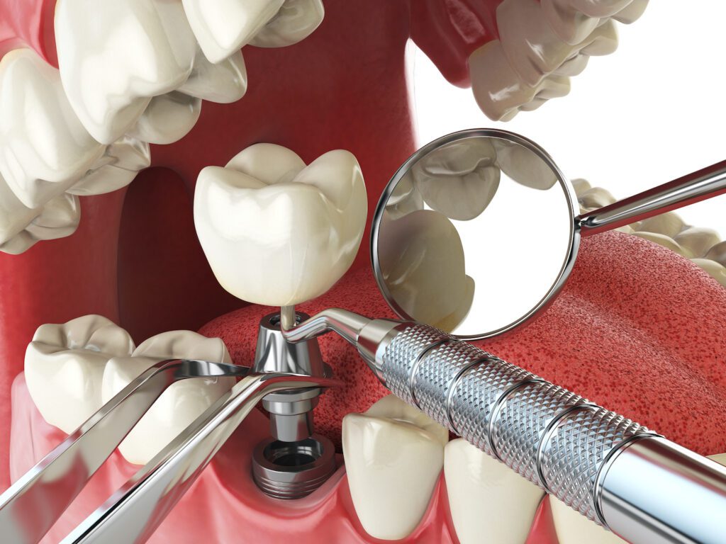 Dental Implants in Tuckahoe, NY, have many benefits over other options
